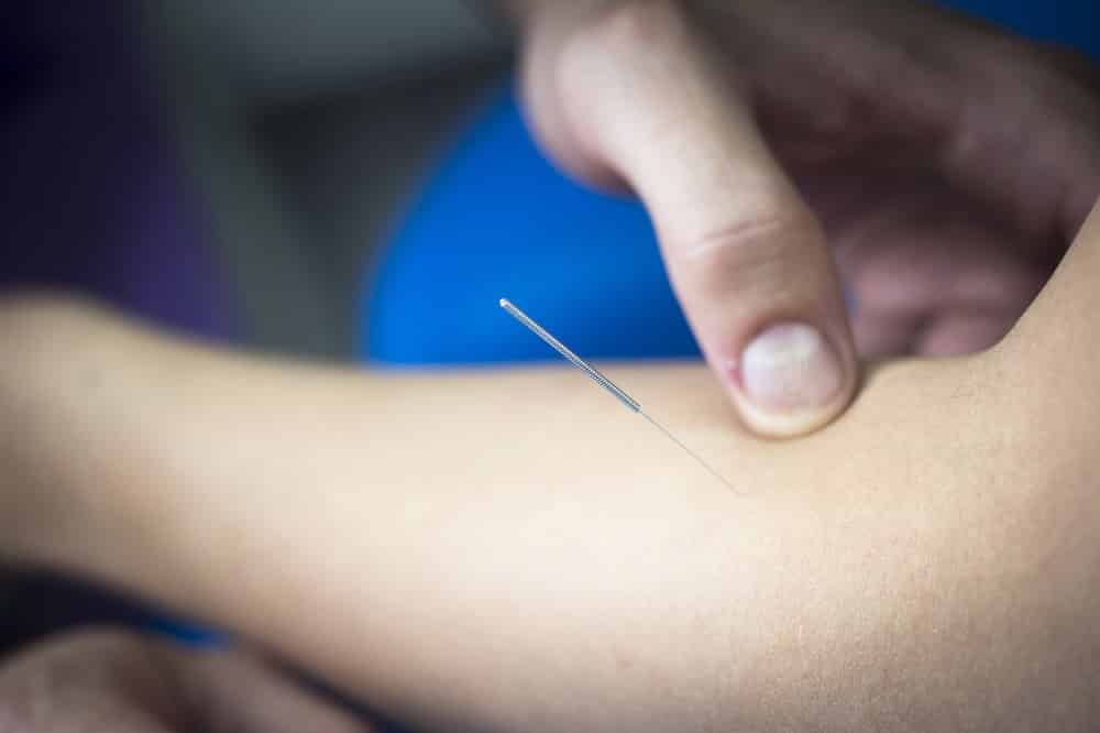 Tennis Elbow And Trigger Point Dry Needling Set Physical Therapy